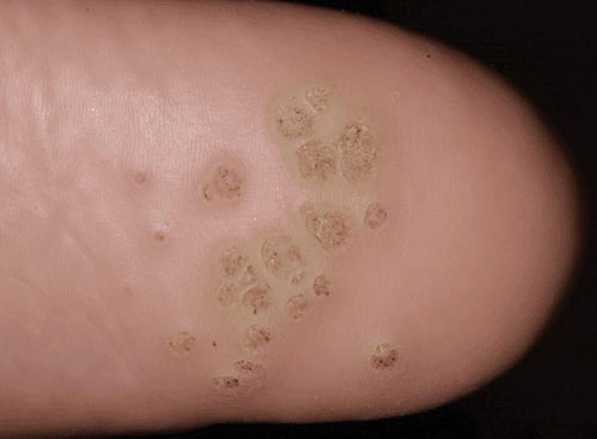 plantar warts high it
